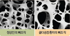 정상인의 뼈조직, 골다공증환자의 뼈조직